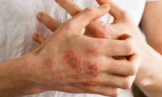 Ảnh hưởng lên da của bệnh đái tháo đường, dấu hiệu không nên bỏ qua