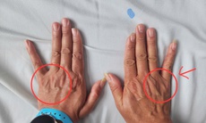 Tê ngón út kéo dài, người đàn ông suýt teo cơ bàn tay