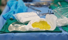 Người phụ nữ tá hoả vì túi ngực vỡ vụn sau 5 năm dù không có cảm giác đau