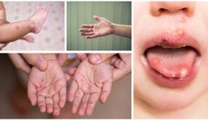 Gần 25.000 ca mắc tay chân miệng, tăng gấp 5 lần: Bộ Y tế chỉ đạo khẩn