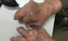 Gout mạn tính gây biến dạng khớp tay, chân xử trí ra sao?