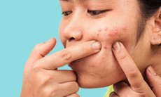 6 thói quen xấu gây mụn trứng cá 