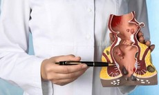 Trĩ xuất huyết: Đừng chủ quan với nguy cơ mất máu nghiêm trọng