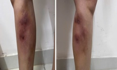 Cẳng chân người phụ nữ 29 tuổi biến dạng vì tiêm filler để làm... thẳng chân tại nhà