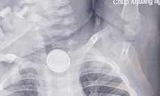 Nuốt pin cúc áo, bé 2 tuổi bỏng nặng thực quản