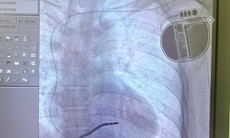 Người đàn ông 3 lần ngất, 1 lần ngưng tim, nguy cơ đột tử cao được cứu nhờ kỹ thuật lần đầu triển khai