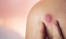 Thực phẩm giúp cải thiện tình trạng mụn nhọt trên da