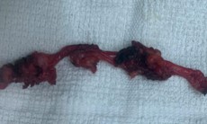 Đau âm ỉ vùng bụng, phát hiện bệnh hiếm nằm sát bàng quang