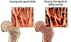5 cách phòng loãng xương không dùng thuốc trước tuổi 40
