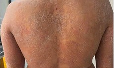Dùng sai thuốc, nấm da lan toàn thân, ngứa dữ dội