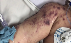 Đã có 4 ca tử vong do não mô cầu, cần biết 4 khuyến cáo phòng bệnh của Bộ Y tế