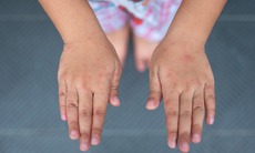 Các cấp độ bệnh tay chân miệng và dấu hiệu cảnh báo