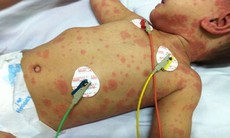 Bé gái 11 tuổi tử vong do viêm não mô cầu: Dấu hiệu nhận biết và cách phòng căn bệnh có nguy cơ tử vong trong 24 giờ