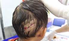 Bé 4 tuổi bị chó nhà cắn, nhiều vết thương nặng ở đầu và tay