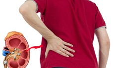 Sỏi thận có gây rối loạn cương dương?