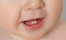 Trẻ chậm mọc răng: nguyên nhân và dấu hiệu cần lưu ý