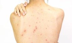 Nguyên nhân mọc mụn trứng cá ở lưng, yếu tố thường gặp nhưng dễ bị bỏ qua