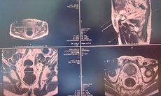 Sinh thiết đích qua tầng sinh môn, bệnh nhân ung thư tiền liệt tuyến được can thiệp kịp thời, điều trị ổn định