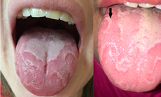 6 lưu ý về lưỡi bản đồ ở trẻ em