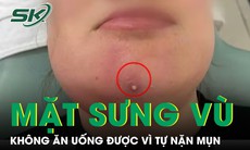 Nặn mụn cằm, người phụ nữ nhập viện vì mặt sưng vù, không ăn uống được 