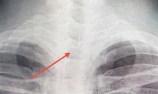Sau ăn cá người đàn ông 46 tuổi bị mắc lưỡi câu sâu trong thực quản