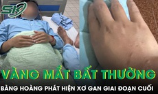 Da và mắt vàng bất thường, chàng trai 21 tuổi bàng hoàng phát hiện xơ gan giai đoạn cuối 