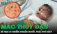 Biến chứng thủy đậu, bé trai 6 tuổi nhiễm khuẩn huyết, phải thở máy nguy kịch