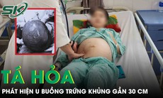 Tá hoả phát hiện khối u buồng trứng ‘cực khủng’ gần 30cm từ dấu hiệu đau bụng