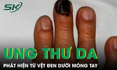 Bàng hoàng phát hiện ung thư da từ vệt đen dưới móng tay