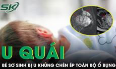 Cứu trẻ sơ sinh 10 ngày tuổi mang khối u hiếm gặp, chèn ép toàn bộ ổ bụng