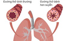 Khi nào người bệnh hen cần đến viện ngay lập tức?