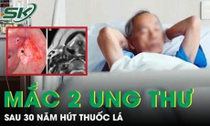 Người đàn ông 56 tuổi mắc cùng lúc hai ung thư sau 30 năm hút thuốc lá