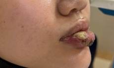 Biến dạng môi sau tiêm 'giải filler' tại spa