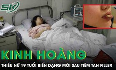 Thiếu nữ 18 tuổi biến dạng môi sau tiêm tan filler tại cơ sở thẩm mỹ chui