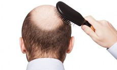 Rụng tóc ở nam giới là dấu hiệu bệnh gì?