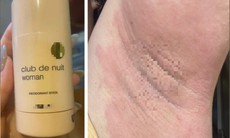 Nổi mề đay, đau nhức vùng nách rồi lan khắp cơ thể sau khi dùng lăn khử mùi 'hàng Nhật' xách tay