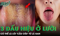 Đừng bỏ qua 3 dấu hiệu bất thường này trên lưỡi, có thể là lời 'cầu cứu' từ lá gan