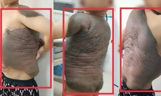 6 lần đại phẫu cắt bỏ khối u 'mai rùa' nặng trĩu trên lưng bé trai 7 tuổi