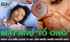 Người phụ nữ chết lặng khi thấy mặt như 'tổ ong', nguy cơ biến dạng vì sai lầm nhiều người mắc
