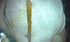 Đi cấp cứu vì tiêu chảy ra máu, phát hiện dị vật dài 3cm đâm thủng đại tràng