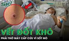 Người phụ nữ 49 tuổi lâm bạo bệnh, phải thở máy cấp cứu chỉ từ một vết đốt khô