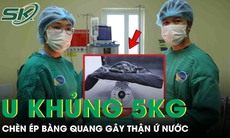 Người phụ nữ 53 tuổi mang khối u xơ tử cung khổng lồ nặng gần 5kg chèn ép bàng quang