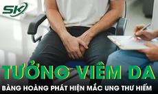 Tưởng viêm da vùng kín suốt 2 năm người đàn ông phát hiện mắc ung thư hiếm