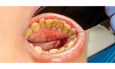 Có cần phải lấy cao răng thường xuyên?
