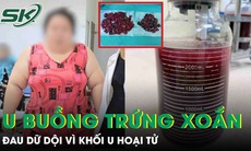 Cô gái nặng 120kg đau bụng dữ dội vì hoại tử khối u buồng trứng xoắn 20cm