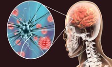 Viêm não tự miễn có nguy cơ tử vong cao nếu chẩn đoán muộn