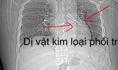 Ho không dứt, bác sĩ phát hiện cán thìa inox mắc trong phế quản bệnh nhân