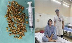 Bác sĩ lấy ra hàng trăm viên sỏi trong túi mật của nữ bệnh nhân 39 tuổi