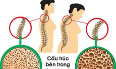 Tuổi nào bắt đầu bị loãng xương và cách phòng bệnh hiệu quả từ sớm