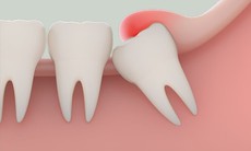 Nhổ răng khôn có nguy hiểm không, khi nào cần nhổ?
